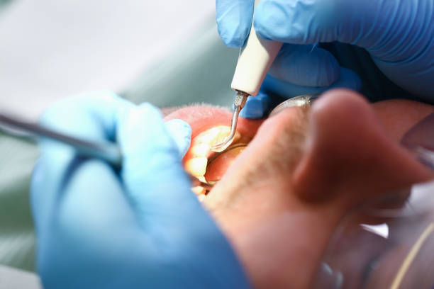 Best Emergency Dentist for Knocked-Out Tooth in Rossmoyne, OH