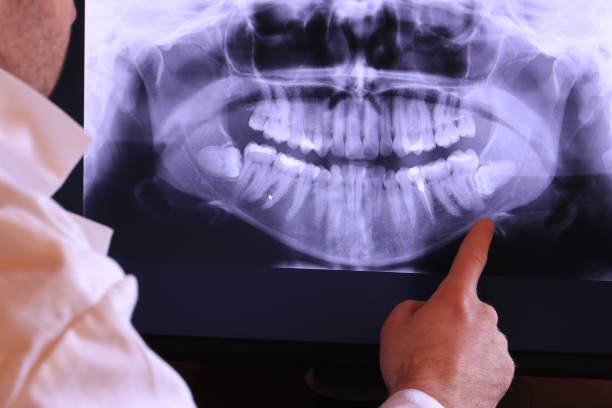 Best Emergency Dental Extractions in Rossmoyne, OH